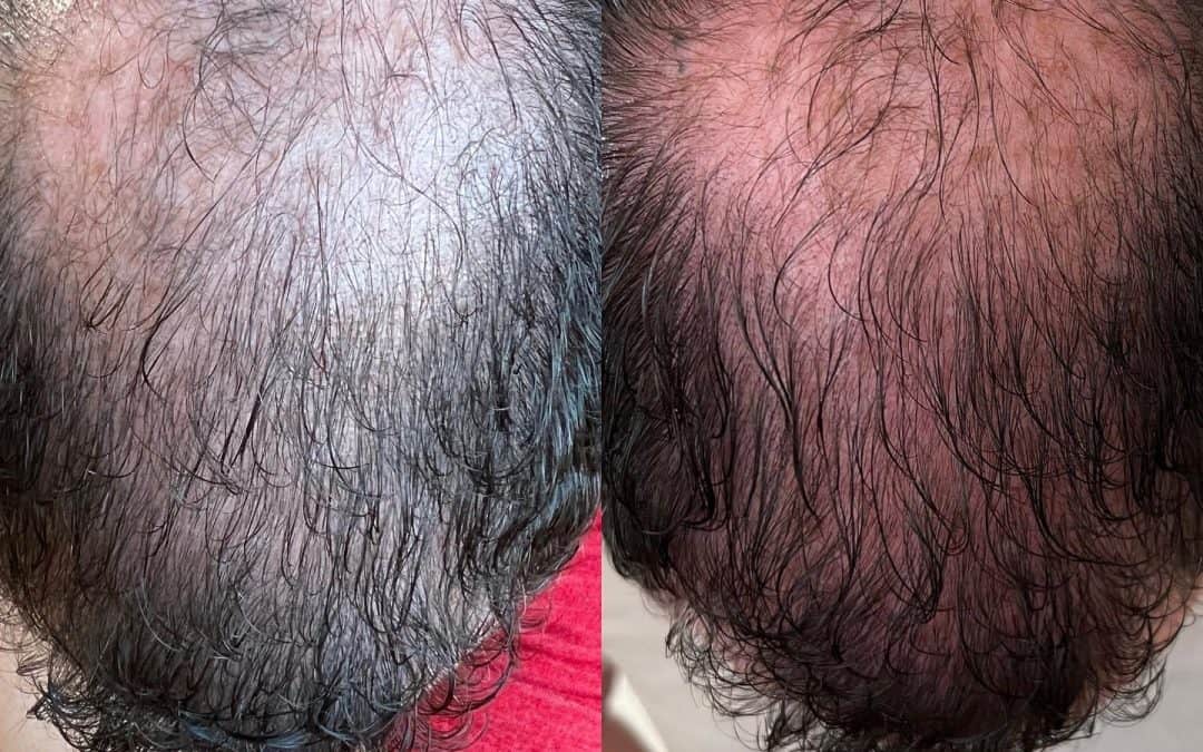 Zach’s Hair Journey